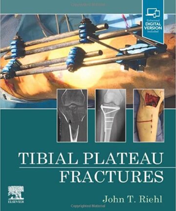 Tibial Plateau Fractures (original pdf)